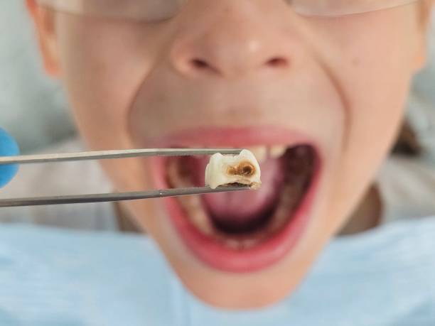 Best Emergency Treatment for Toothache in Victoria, TX